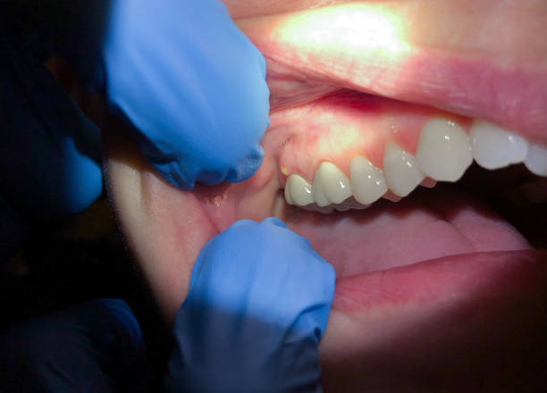 Best Emergency Root Canal Treatment in Reidsville, GA